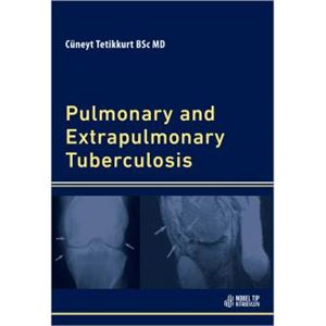 pulmonary-and-extrapulmonary-tuberculosis4463b2821bf46e8c05b7b707cc2cce66.jpg
